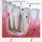 General Guideline to Dental Implants Procedure