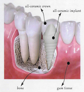 low cost dental implants in tampa