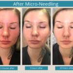 What total does micro-needling cost?